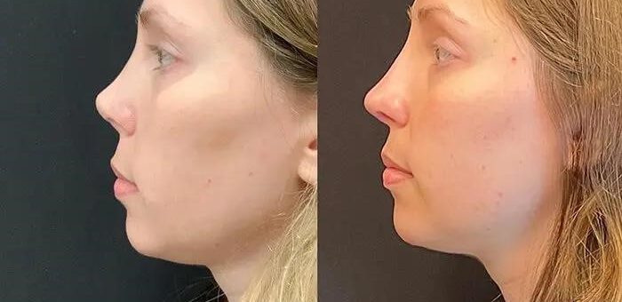 What causes eyebrow pain? – closed rhinoplasty near me.