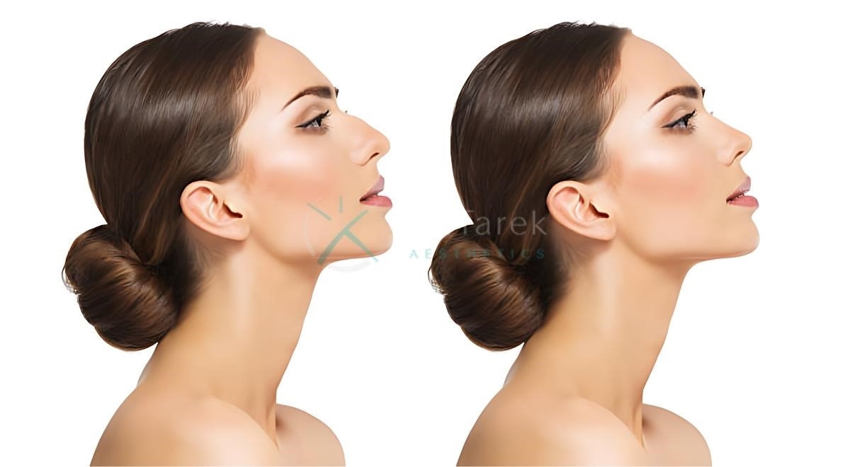 closed rhinoplasty