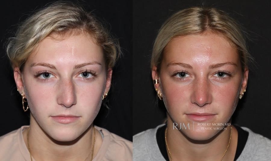 closed rhinoplasty
