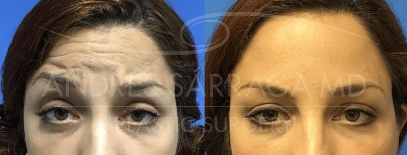 closed rhinoplasty