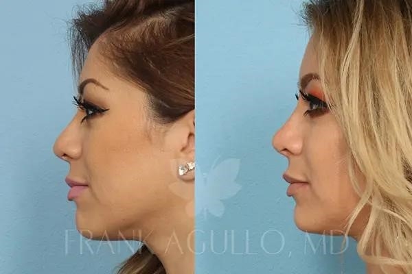closed rhinoplasty near me
