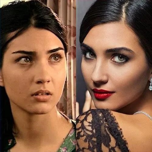 closed rhinoplasty